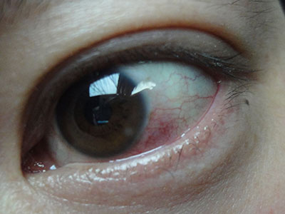 眼睛突出變大是什麼病？
