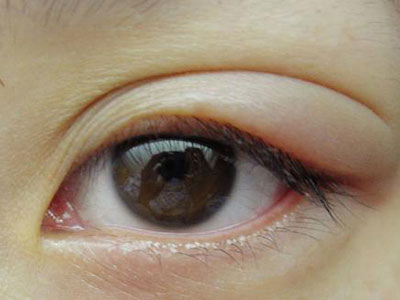 如何辨別是否患沙眼？
