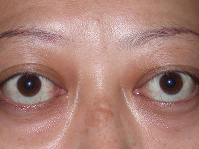 眼結膜出血可能預示著某些疾病發生