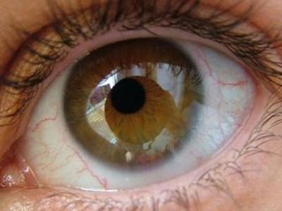 眼睛出現疾病前都有哪些危險前兆