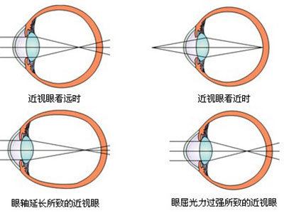 愛瞇著眼睛看東西是得近視了嗎？