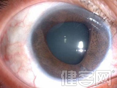 解析玻璃體混濁的臨床表現