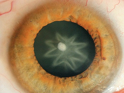老年人晚年容易患的5種眼睛疾病