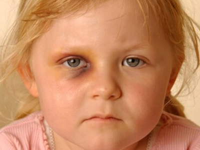 兒童眼底病的預防方法有哪些