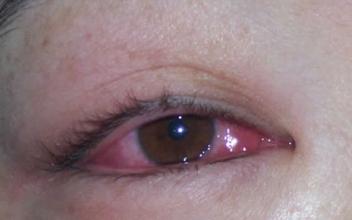 紅眼病預防 預防紅眼病要注意什麼