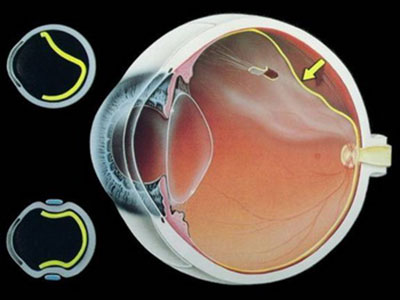 視網膜治療後要注重保養