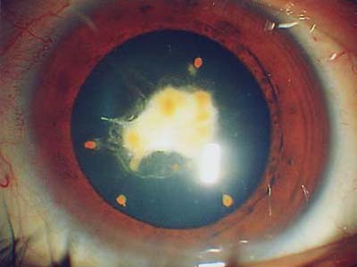 視網膜脫離的中醫辨證施治