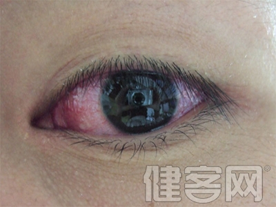 有哪些眼睛疾病適合看中醫？