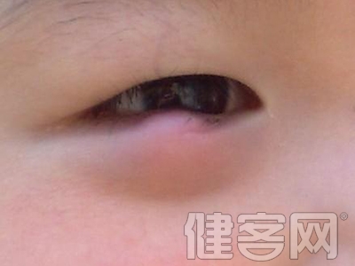 治療麥粒腫的方法:中醫刮痧