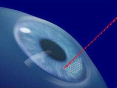 能不能做激光近視手術 關鍵看角膜