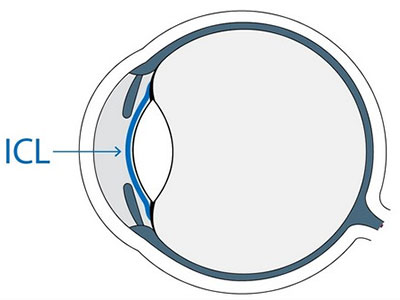 icl人工晶體植入術會有不良反應嗎？