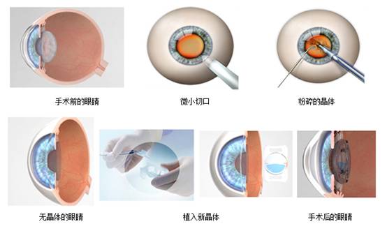 白內障超聲乳化技術優勢分析