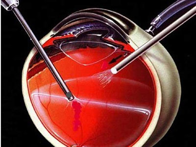 玻璃體切割術治療視網膜脫離