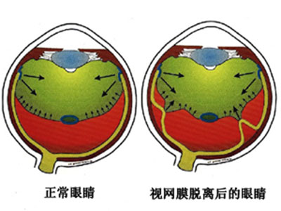 治療視網膜脫離 手術成功率高