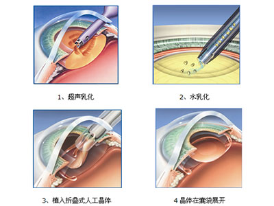 白內障治療新法：囊外摘除術