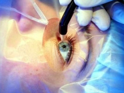 揭秘：眼科醫生為什麼不做近視手術？