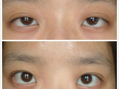 雙眼皮手術可能會留下後遺症
