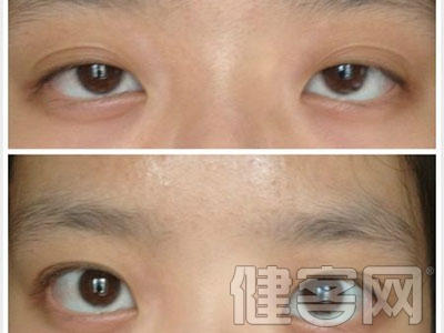 介紹四種熱門的開眼角手術