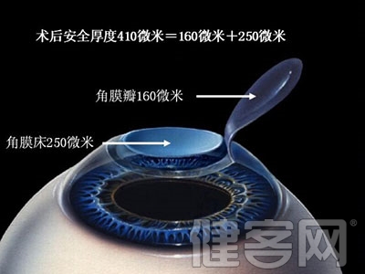 圓錐角膜——不能忽視的LASIK手術後遺症