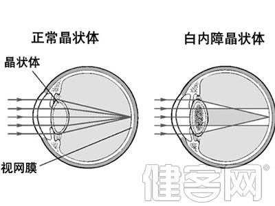 白內障術後還會復發嗎？