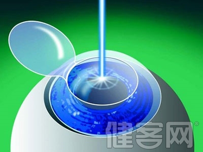 激光矯正近視 不是想做就能做