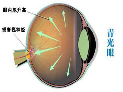 青光眼為什麼會“瞄”上年輕人