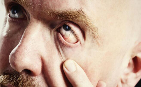 青光眼最愛這五類人 青光眼的早期症狀
