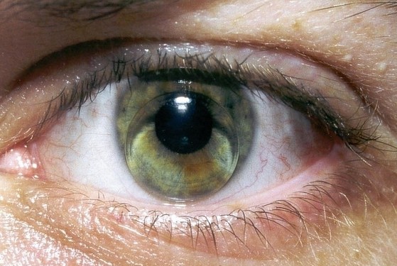 憂傷過度或引發青光眼 青光眼發生的七大原因