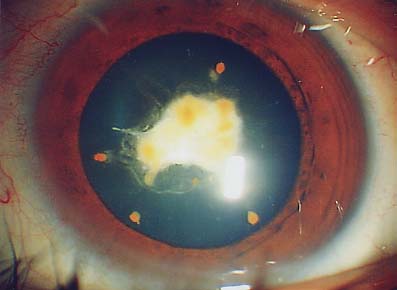 近視眼驗光無法查出青光眼 青光眼的症狀是什麼