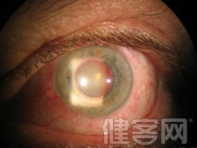 開角型青光眼與基因變異有關