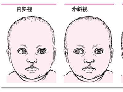 隐性斜视图片图片