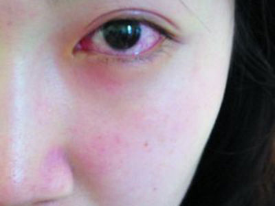 不同階段眼外傷症狀不同 眼睛受傷時如何讓處理？