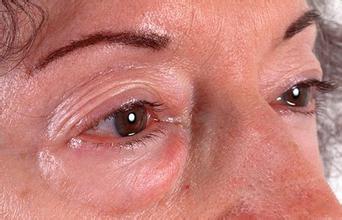 眼部腫瘤到底有什麼症狀？