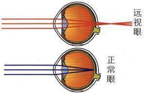 遠視眼的臨床症狀是什麼