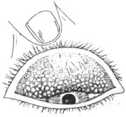 感染沙眼 可能引發多種疾病