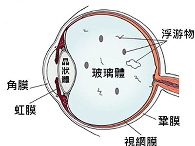 得了飛蚊症要緊嗎？