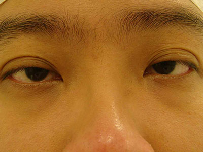 眼皮下垂是什麼原因？怎麼恢復？