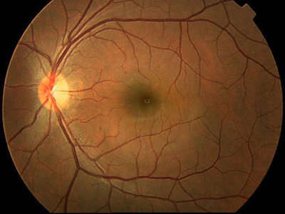 視網膜色素變性可以治愈嗎？