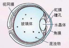 玻璃體混濁的治療以及護理