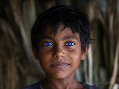 孟加拉男孩長有如同“異鬼”一樣藍色瞳孔