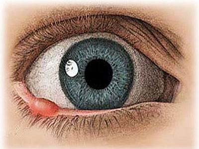慢性眼睑炎的分類