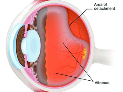 眼底出血對眼睛有害嗎？