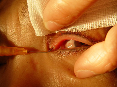 眼睑周的小“疙瘩”原是汗管瘤？