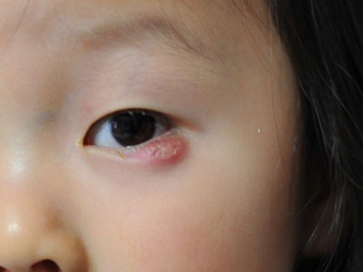 男嬰長霰粒腫 延誤治療變成三角眼