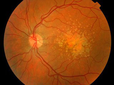 黃斑裂孔可以導致失明