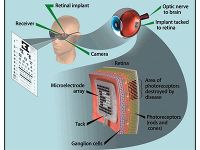 先進仿生設備 讓眼睛重獲光明