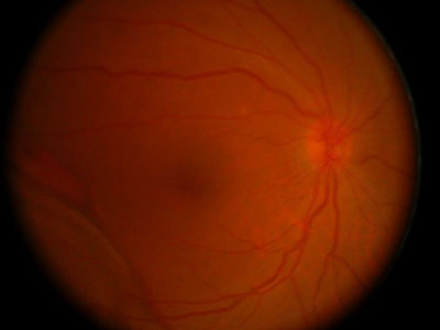 外層滲出性視網膜病變診療指南