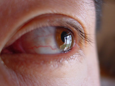 治不好的“紅眼病”原來是鞏膜炎