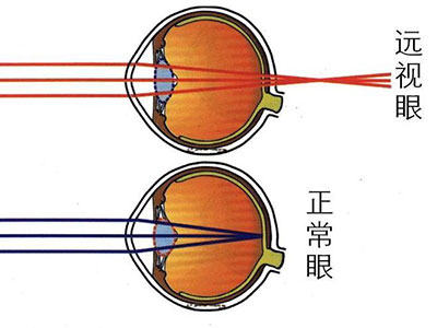 李若彤也是遠視眼 遠視問題不容小觑