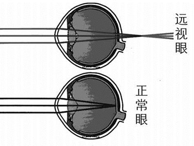 兒童12歲前出現遠視不必急著矯正